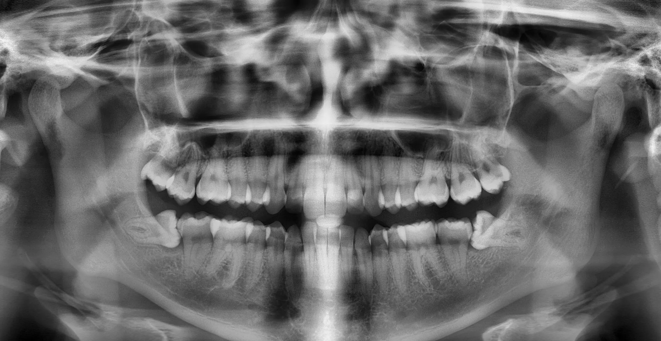 Radiografía panorámica dental analizada por iAngela con hallazgos destacados